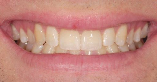Heninger Dental: Dr Cam Heninger in Orem Teeth 2 After