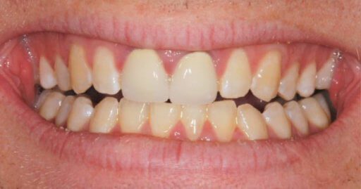 Heninger Dental: Dr Cam Heninger in Orem Teeth 2 Before