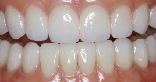 Heninger Dental: Dr Cam Heninger in Orem Teeth 3 After