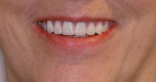 Heninger Dental: Dr Cam Heninger in Orem Teeth 4 After