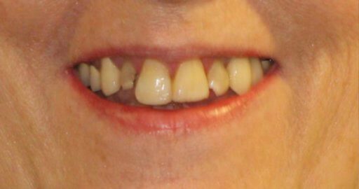 Heninger Dental: Dr Cam Heninger in Orem Teeth 4 Before