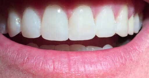 Heninger Dental: Dr Cam Heninger in Orem Teeth 5 After